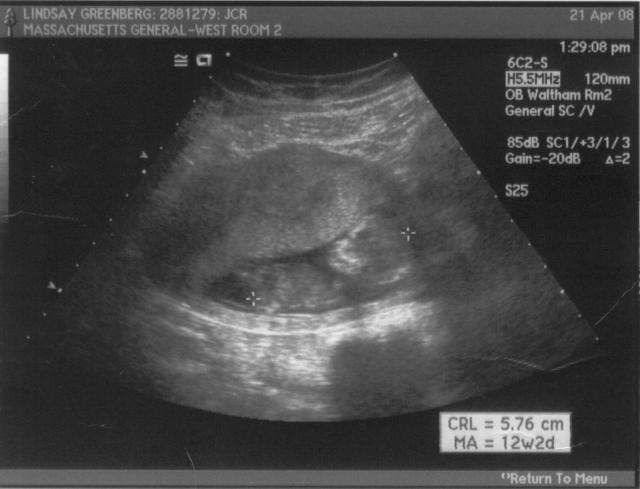 ultrasound - 2008-04-21 (12 week) - 3.jpg