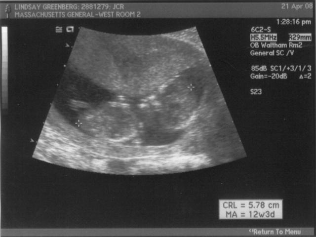 ultrasound - 2008-04-21 (12 week) - 4.jpg