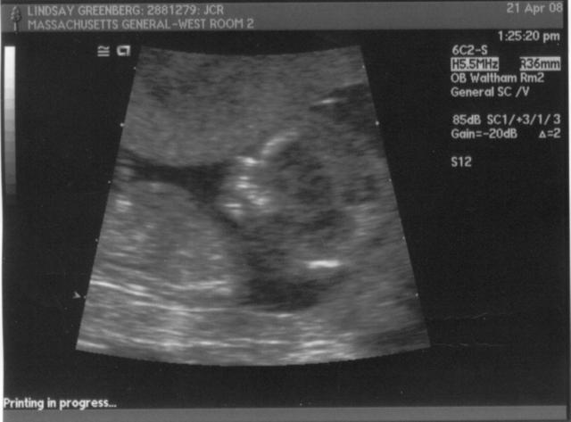 ultrasound - 2008-04-21 (12 week) - 5.jpg